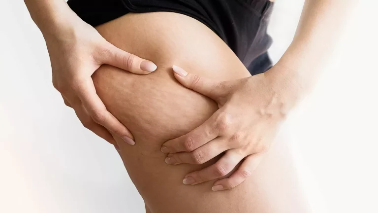 Cellulite  : Palper-rouler 0 (0)